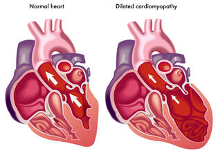 Normal heart and Dilated Cardiomyopathy